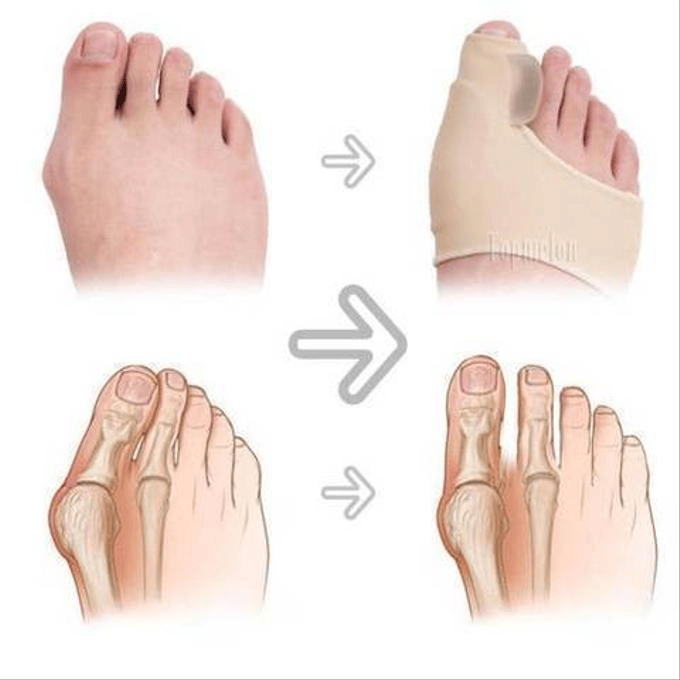 Correcteur Orthopédique - l’hallux valgus (oignon)