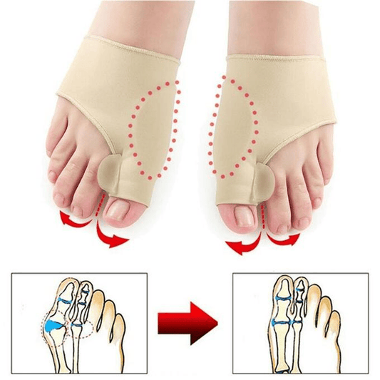 Correcteur Orthopédique - l’hallux valgus (oignon)